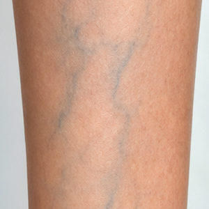 Veias Azuis
